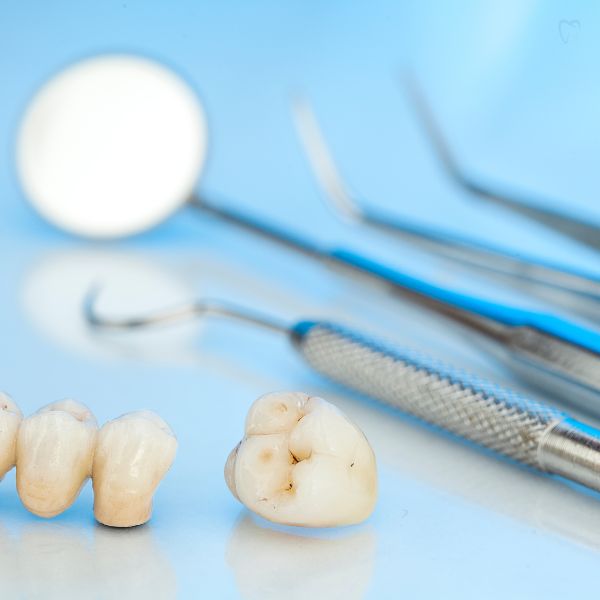 Coroas Dentárias: Conheça os Diferentes Tipos e Suas Vantagens.