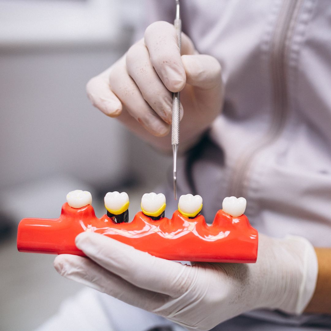 Escolher a coroa dentária correta é essencial para garantir não apenas a saúde bucal, mas também a estética do sorriso.