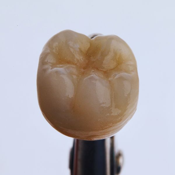 Coroa de Porcelana ou Resina: Qual a Melhor Escolha para seus Dentes.