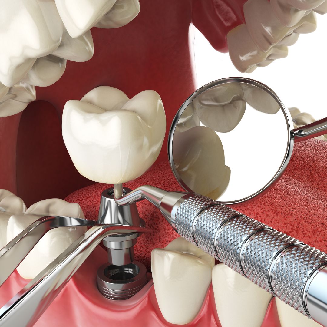 Essa técnica permite que o paciente recupere a funcionalidade e a estética do sorriso em tempo recorde, saindo do consultório com um novo dente no mesmo dia da cirurgia.