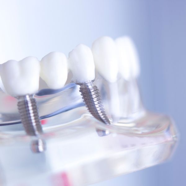 Implantes com Prótese Overdenture Transformam a Reabilitação Oral.