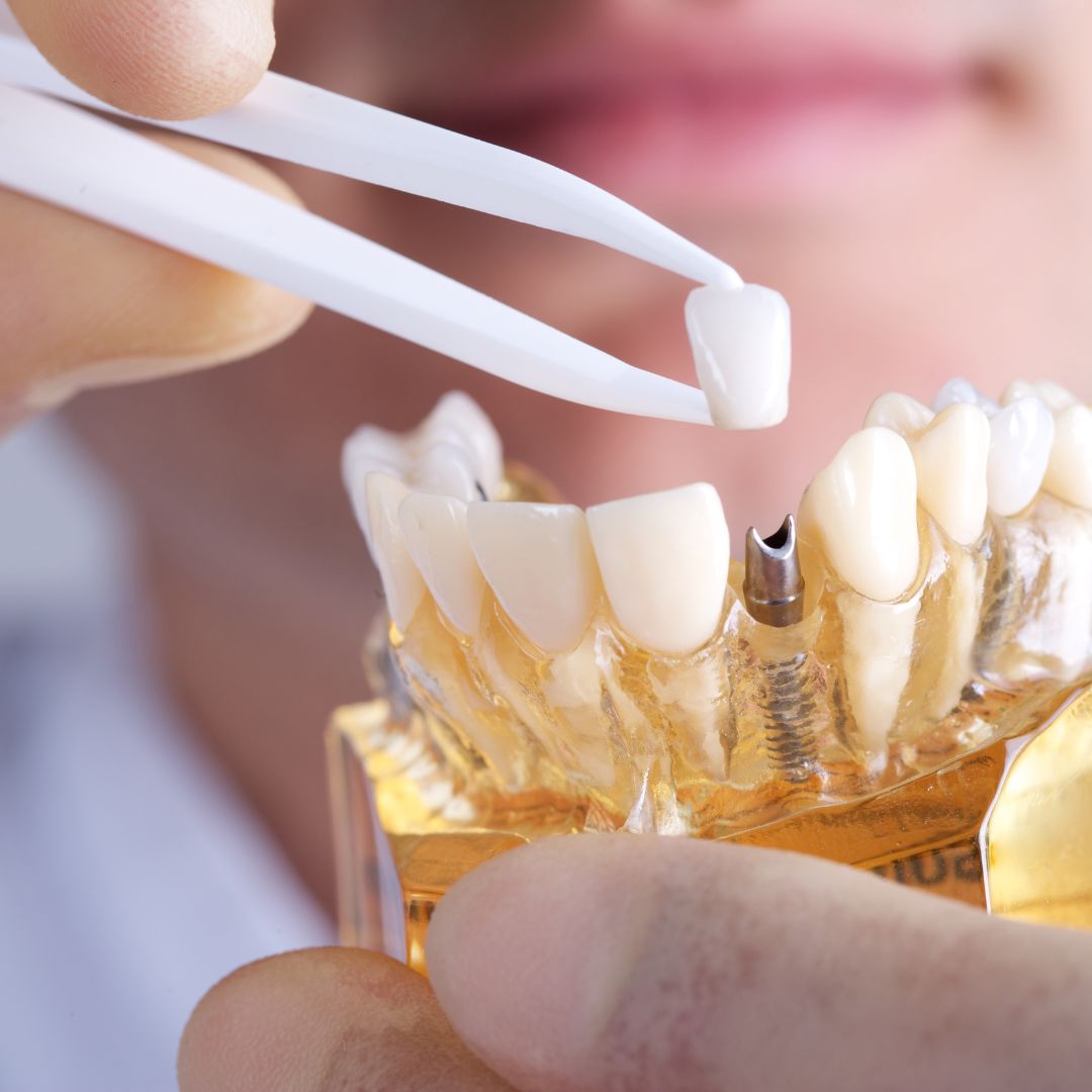 Existem diferentes opções de implantes, sendo os unitários indicados para a substituição de um único dente e os duplos para dois dentes em sequência.